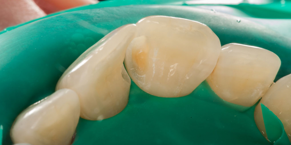 Лечение кариеса и реставрация передних зубов - фото №6