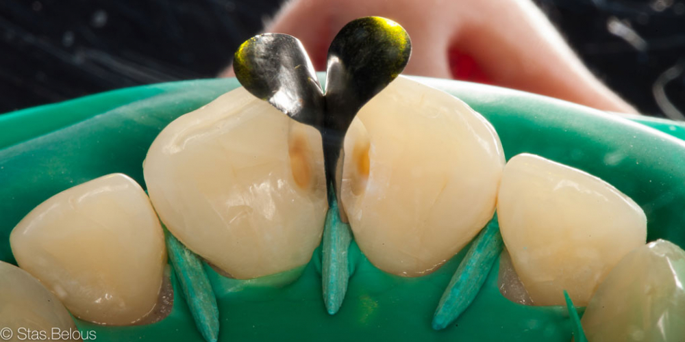 Лечение кариеса и реставрация передних зубов - фото №7