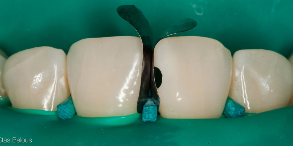 Лечение кариеса и реставрация передних зубов - фото №8