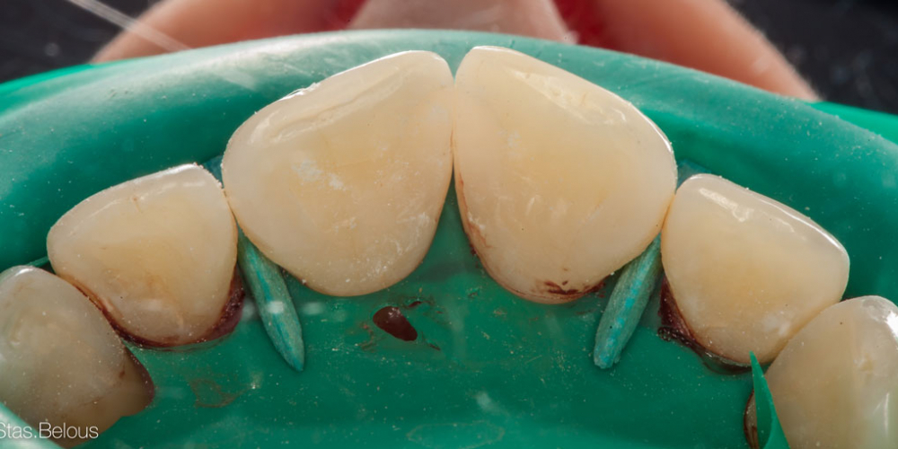 Лечение кариеса и реставрация передних зубов - фото №9