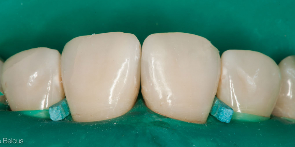 Лечение кариеса и реставрация передних зубов - фото №10