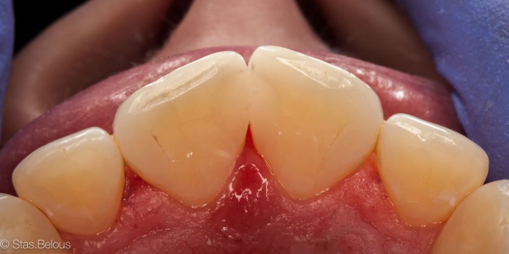 Лечение кариеса и реставрация передних зубов - фото №11