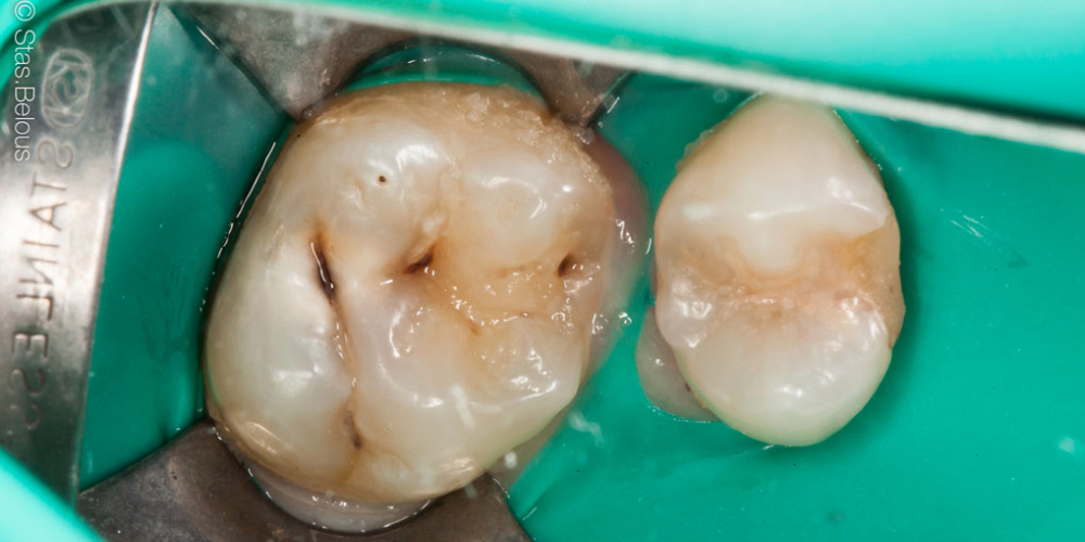 Лечение кариеса двух зубов в одно посещение - фото №1