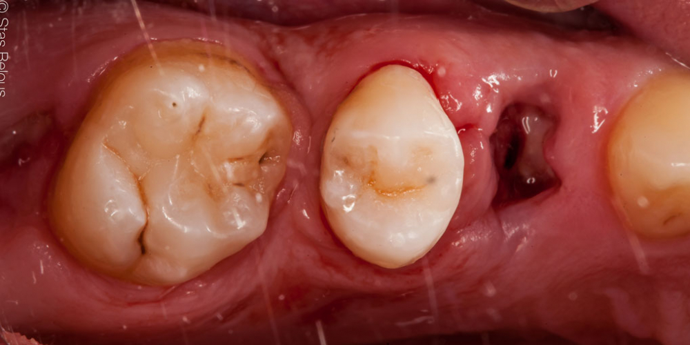 Лечение кариеса двух зубов в одно посещение - фото №5