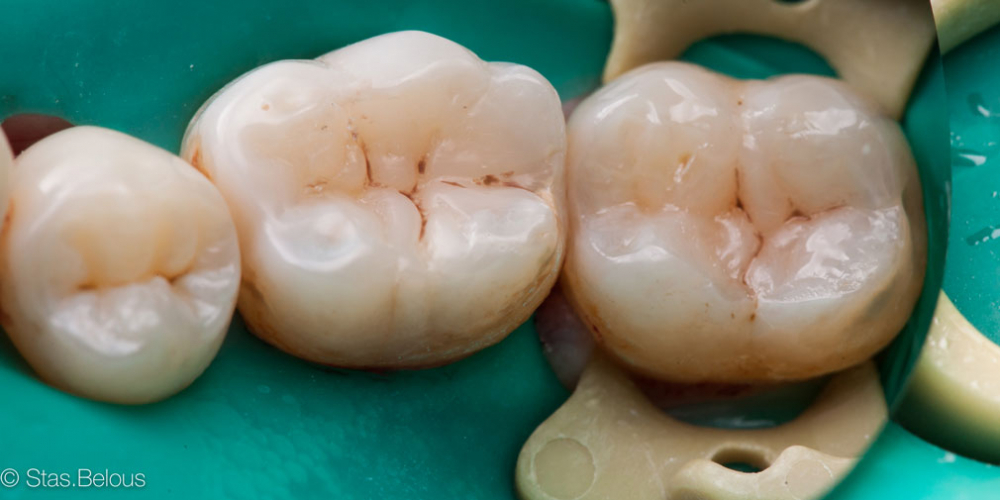 Лечение глубокого кариеса 36 и 37 зуба - фото №5