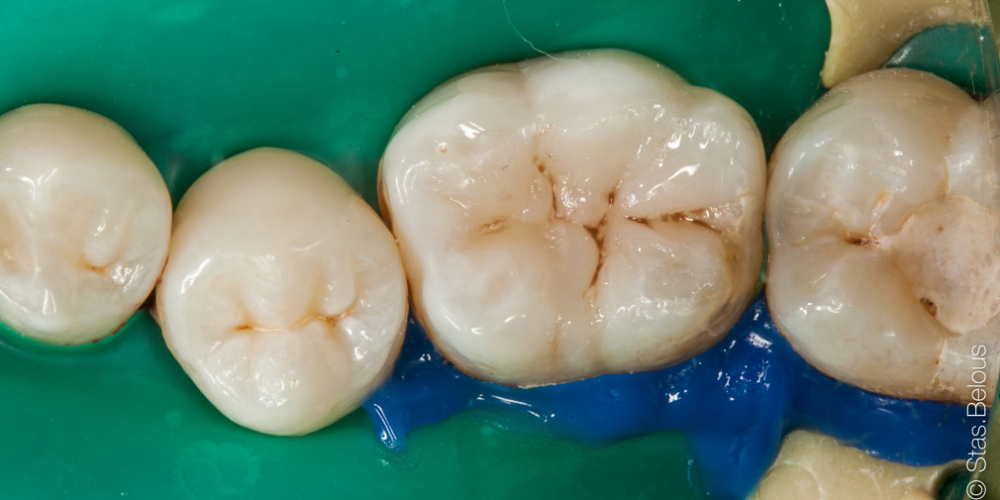 Лечение глубокого кариеса 36 и 37 зуба - фото №4