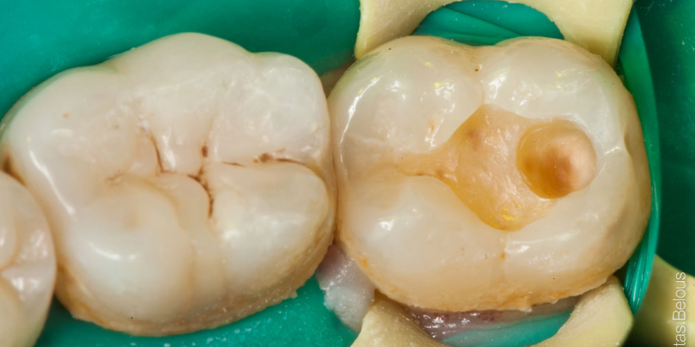 Лечение глубокого кариеса 36 и 37 зуба - фото №2