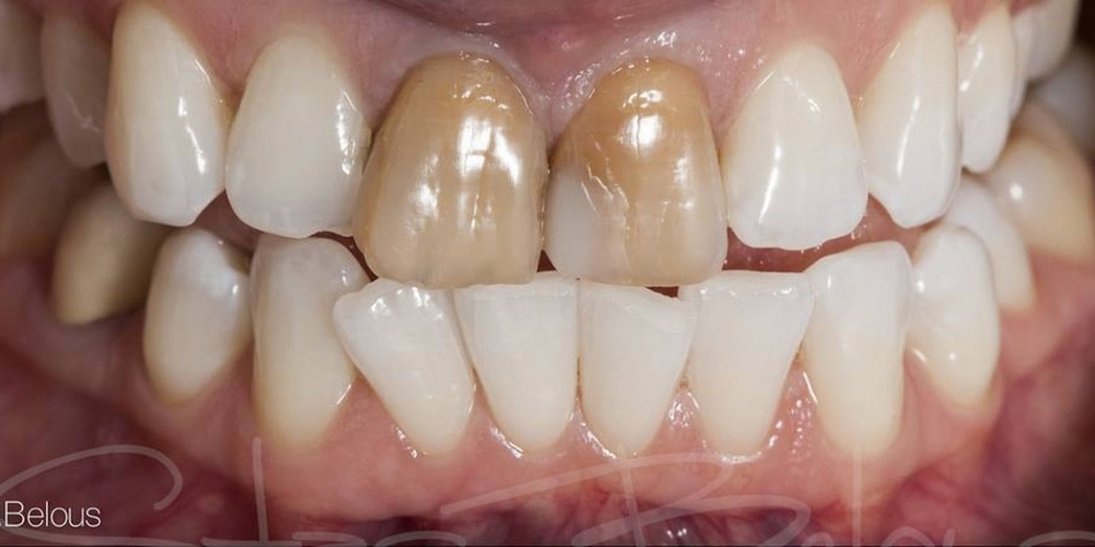 Временные реставрации по форме своих собственных зубов - фото №1