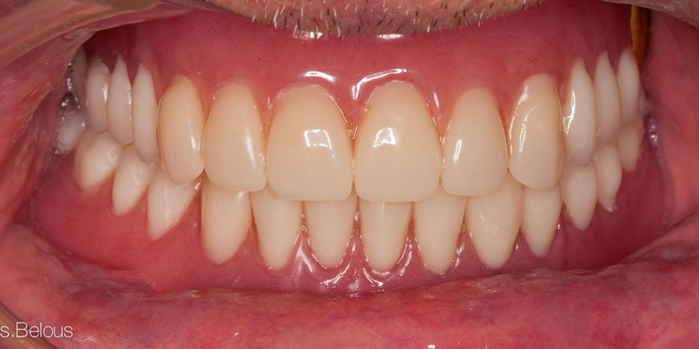Восстановление прикуса полными съемными протезами при отсутствии всех зубов - фото №2