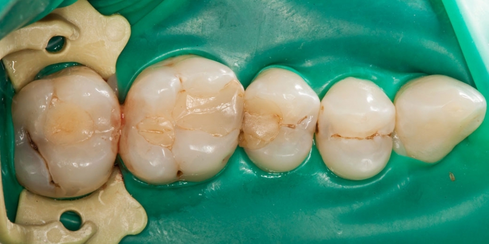 Лечение кариеса (беспокоило застревание пищи между зубами) - фото №1