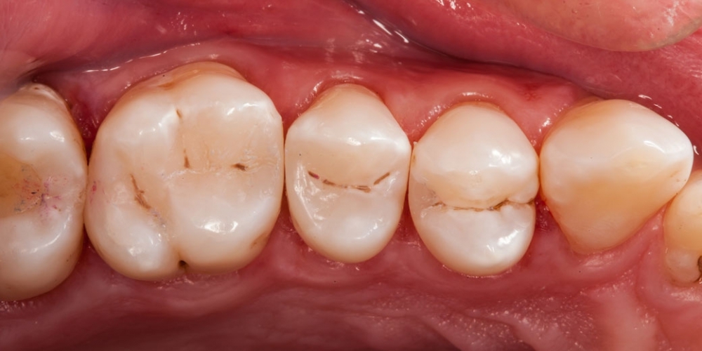 Лечение кариеса (беспокоило застревание пищи между зубами) - фото №5