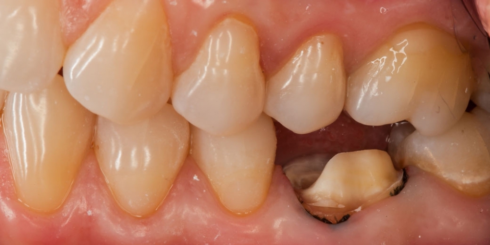 Восстановление зуба цельнокерамической коронкой смоделированной в 3D - фото №1