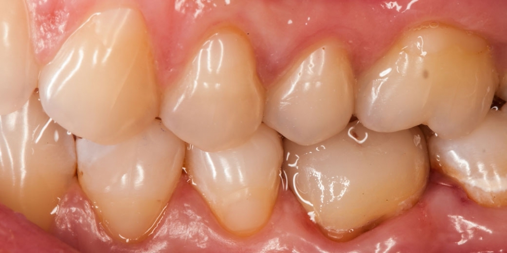 Восстановление зуба цельнокерамической коронкой смоделированной в 3D - фото №10