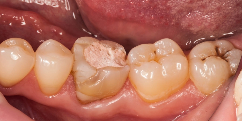 Восстановление зуба цельнокерамической коронкой смоделированной в 3D - фото №3