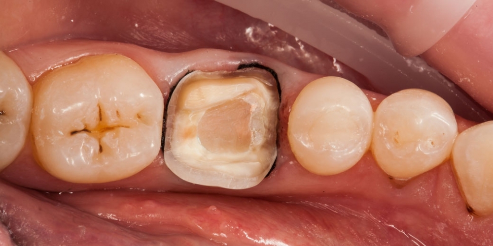 Восстановление зуба цельнокерамической коронкой смоделированной в 3D - фото №4