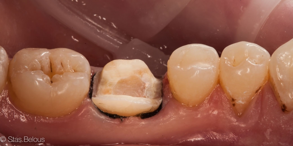 Восстановление зуба цельнокерамической коронкой смоделированной в 3D - фото №5
