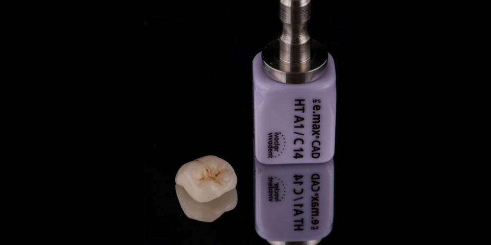 Восстановление зуба цельнокерамической коронкой смоделированной в 3D - фото №6