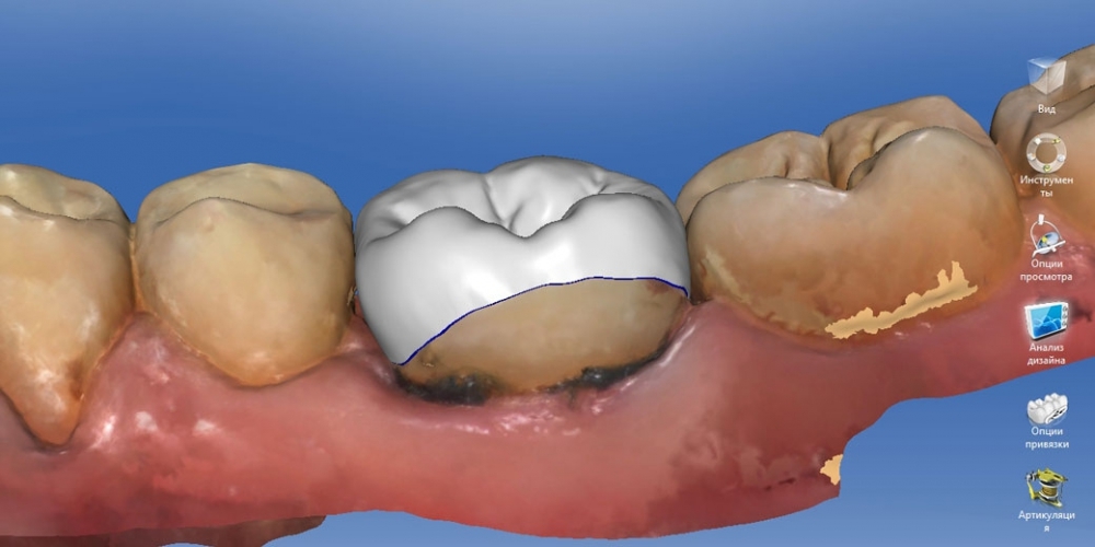 Восстановление зуба цельнокерамической коронкой смоделированной в 3D - фото №7