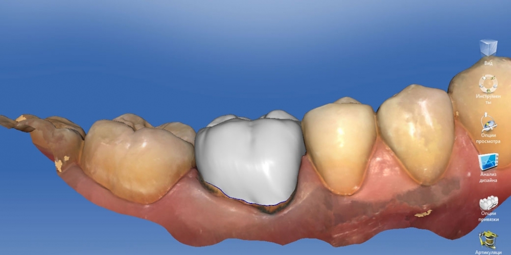 Восстановление зуба цельнокерамической коронкой смоделированной в 3D - фото №8