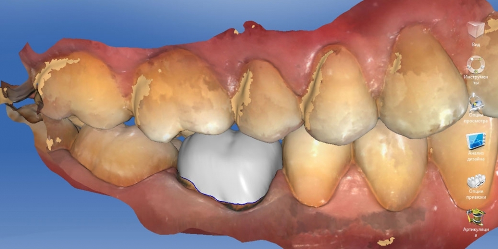 Восстановление зуба цельнокерамической коронкой смоделированной в 3D - фото №9