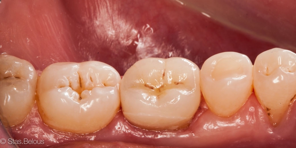 Восстановление зуба цельнокерамической коронкой смоделированной в 3D - фото №2