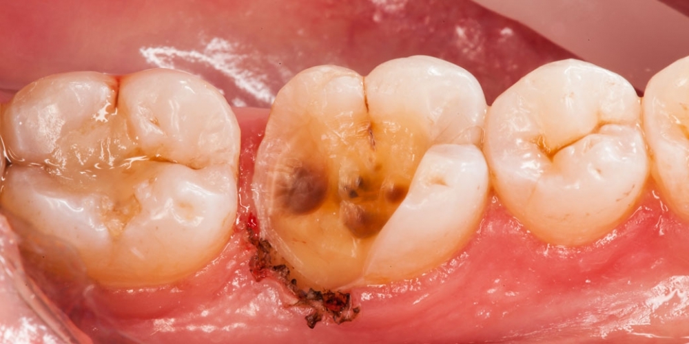 Восстановление разрушенного зуба керамической вкладкой - фото №1
