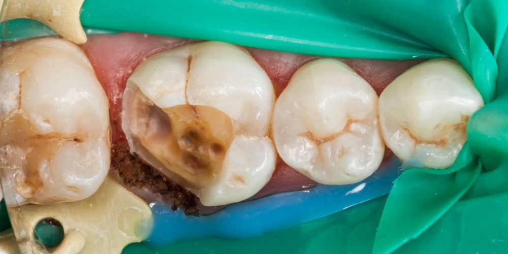 Восстановление разрушенного зуба керамической вкладкой - фото №4