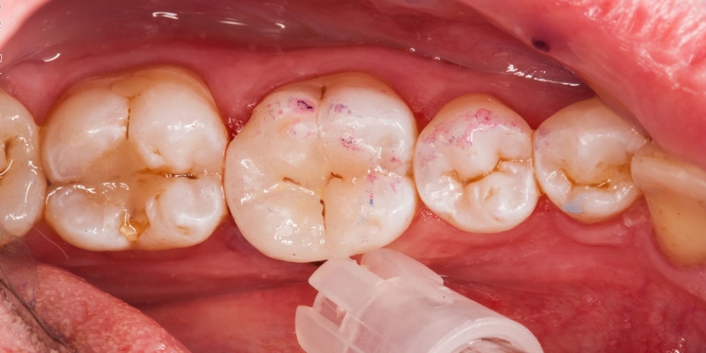 Восстановление разрушенного зуба керамической вкладкой - фото №2