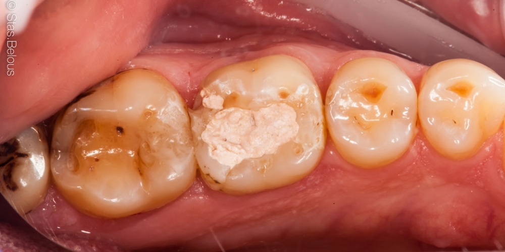 Восстановление разрушенного зуба керамической полукоронкой - фото №1