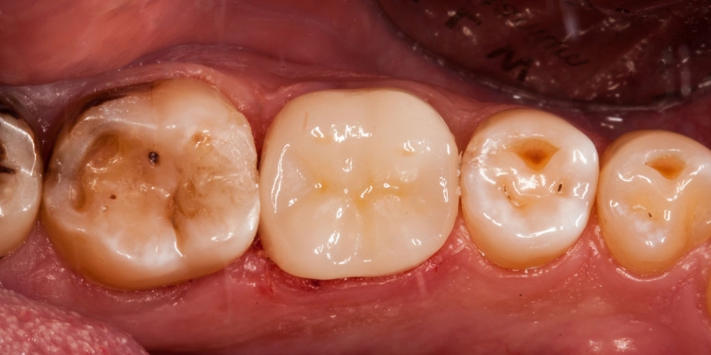 Восстановление разрушенного зуба керамической полукоронкой - фото №5