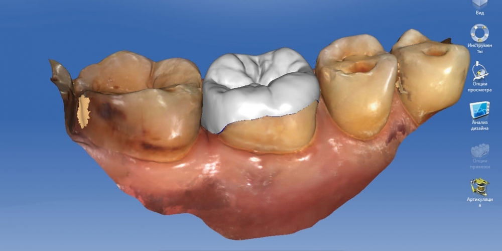 Восстановление разрушенного зуба керамической полукоронкой - фото №4