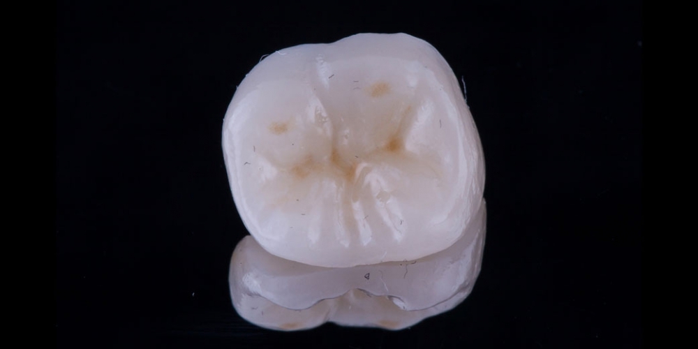 Восстановление разрушенного зуба керамической полукоронкой - фото №2