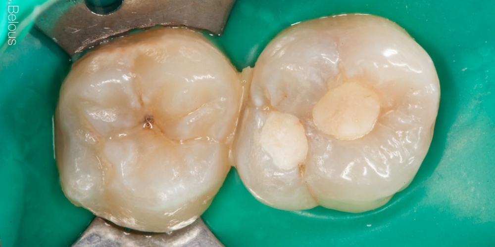 Результат лечения кариеса, реставрация жевательного зуба - фото №1