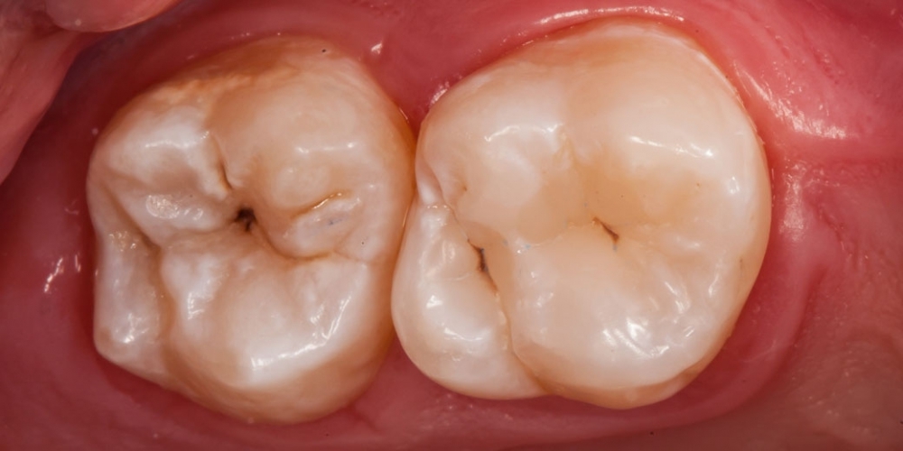 Результат лечения кариеса, реставрация жевательного зуба - фото №6