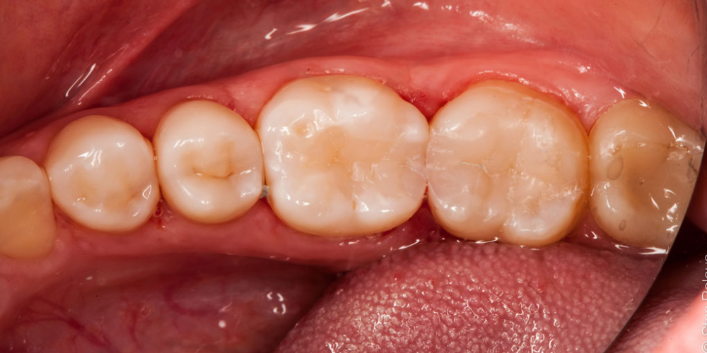 Жалоба на застревание пищи между зубами 36 и 37 - фото №4