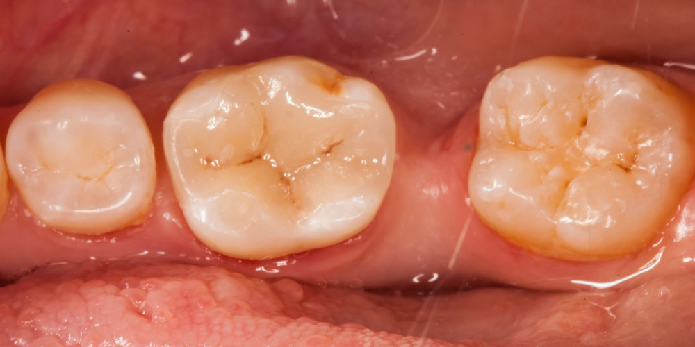 Цельнокерамическая реставрация жевательного зуба - фото №4