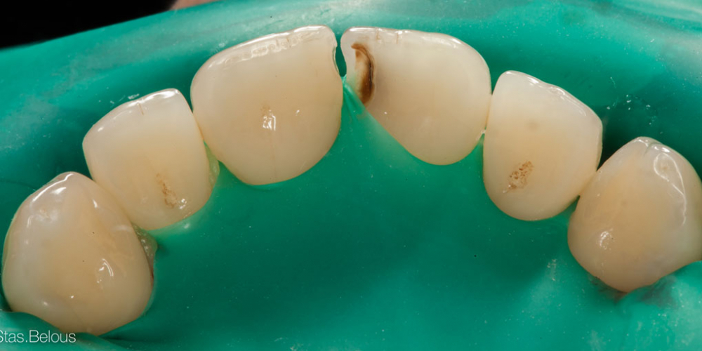 Лечение кариеса и реставрация скола на переднем зубе - фото №1
