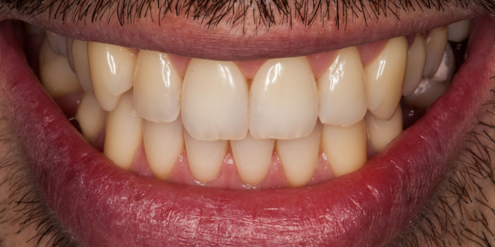 Лечение кариеса и реставрация скола на переднем зубе - фото №8