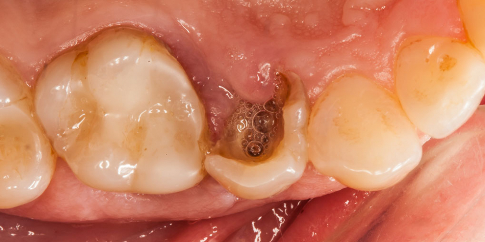 Скол депульпированного зуба (без нерва) - фото №1