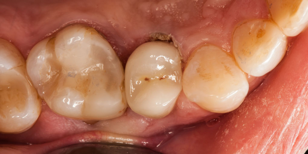 Скол депульпированного зуба (без нерва) - фото №4