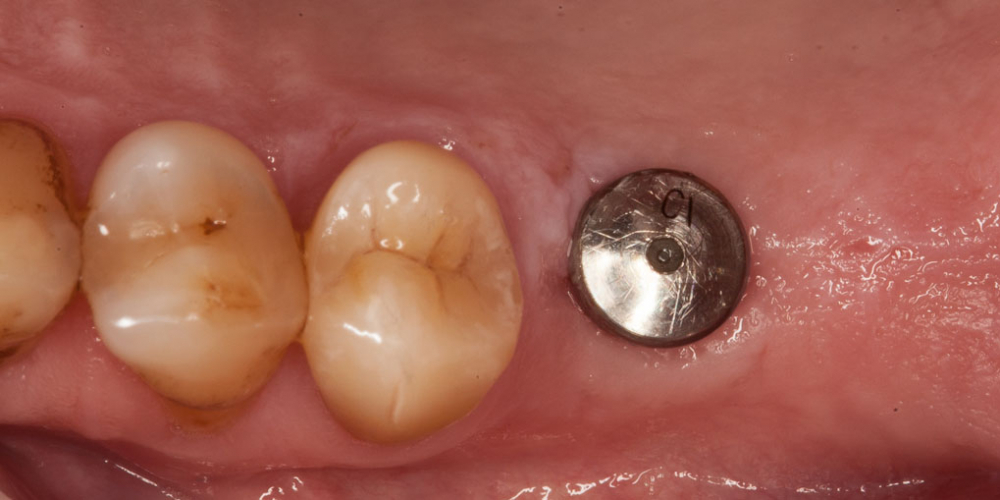 Протезирование зуба после имплантации - фото №1