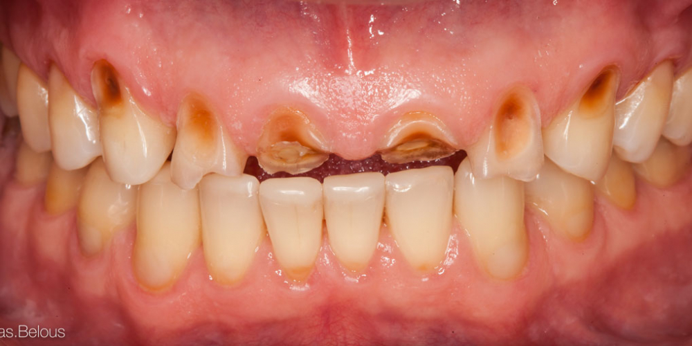 Полное воссоздание верхнего зубного ряда - фото №1