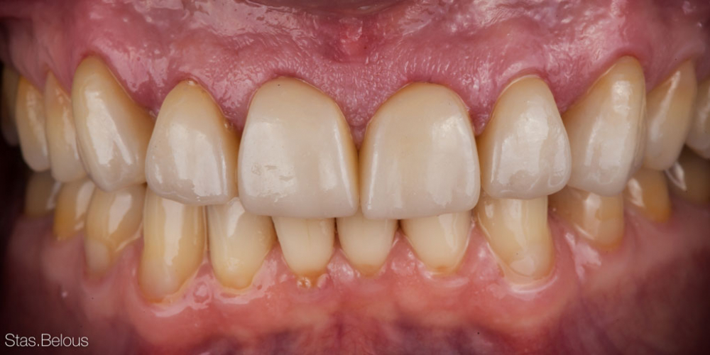Полное воссоздание верхнего зубного ряда - фото №9