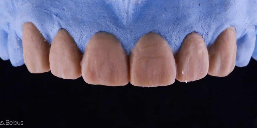 Полное воссоздание верхнего зубного ряда - фото №3