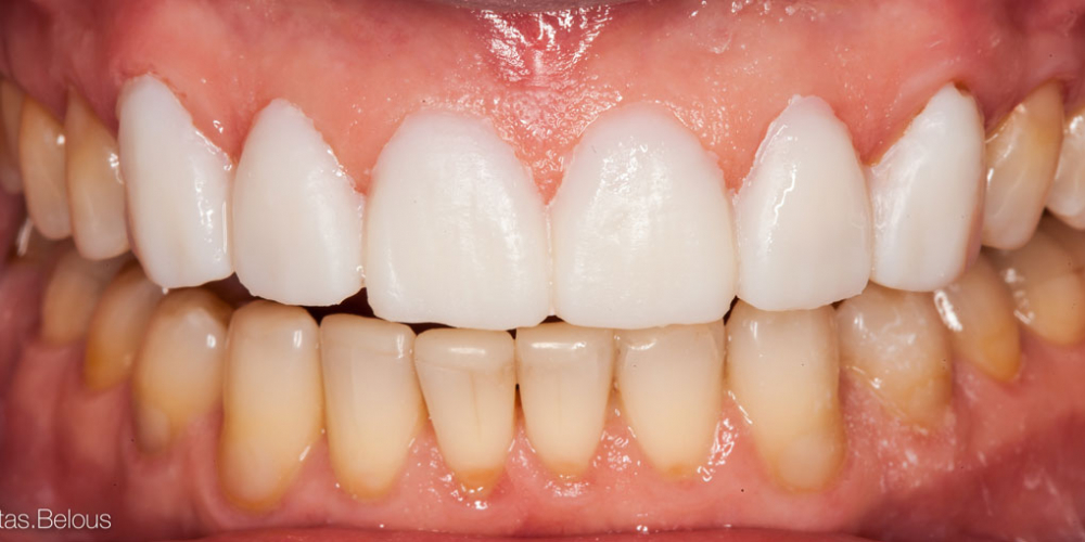 Полное воссоздание верхнего зубного ряда - фото №4