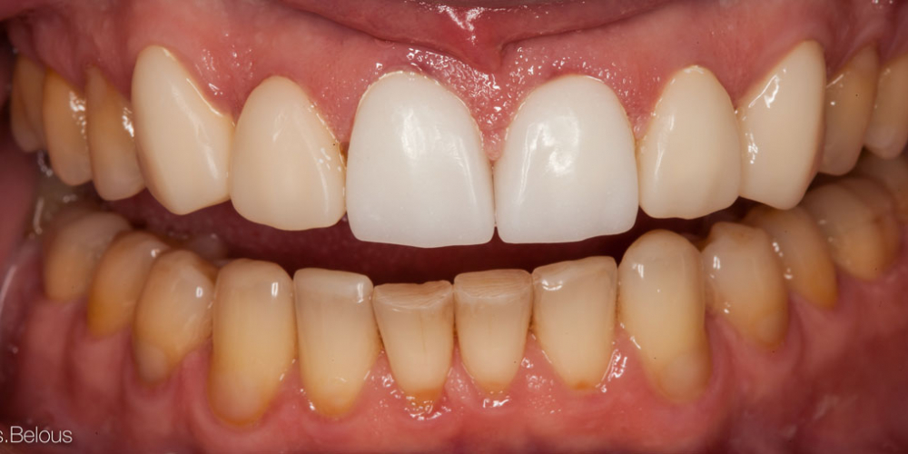 Полное воссоздание верхнего зубного ряда - фото №6