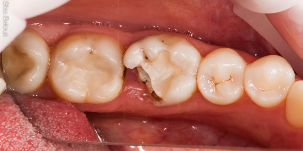 Восстановление отколотого зуба полукоронкой - фото №1