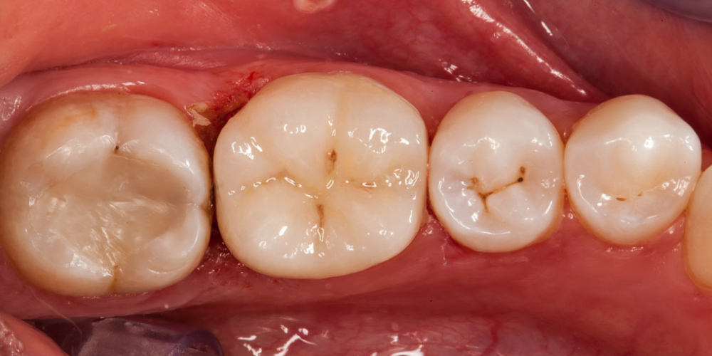 Восстановление отколотого зуба полукоронкой - фото №5