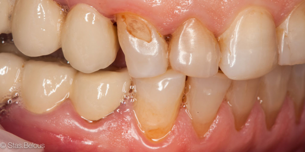 Восстановление утраченных тканей зуба коронкой Cerec - фото №1