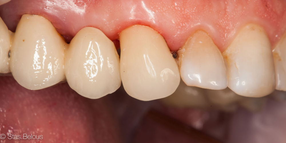 Восстановление утраченных тканей зуба коронкой Cerec - фото №4
